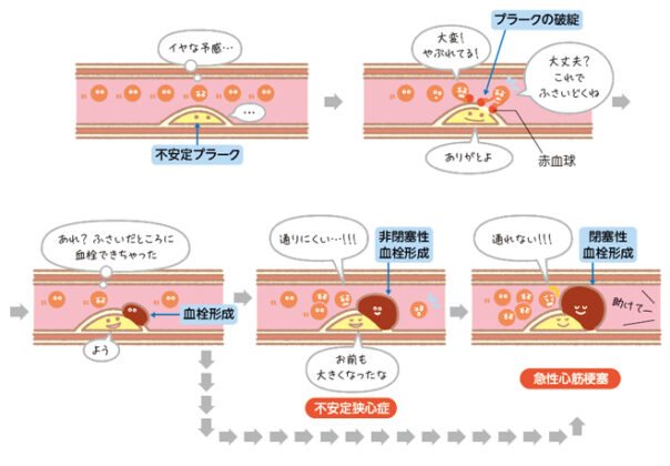 急性冠症候群：ACS| かんテキWeb