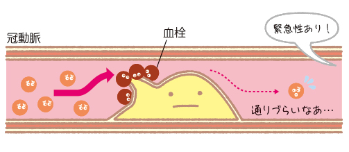 非st上昇型急性心筋梗塞 Nstemi かんテキweb