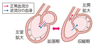 僧帽弁閉鎖不全症について｜和歌山県立医科大学 内科学第4講座