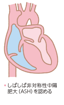 症例に学ぶ 肥大型心筋症 大型本（大型本） 肥大型心筋症ハンドブック | 今泉 勉, 古賀 義則 |本 | 通販