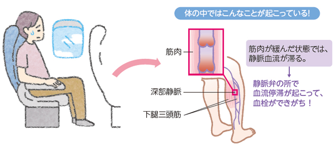 深部静脈血栓症：DVT| かんテキWeb