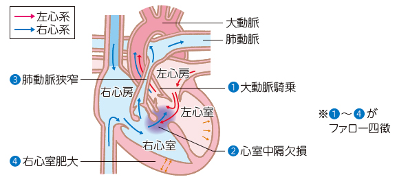 ファロー四徴症の原因と危険因子は何ですか?