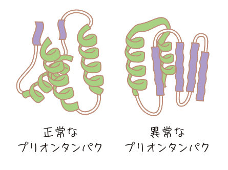 プリオン病：| かんテキWeb