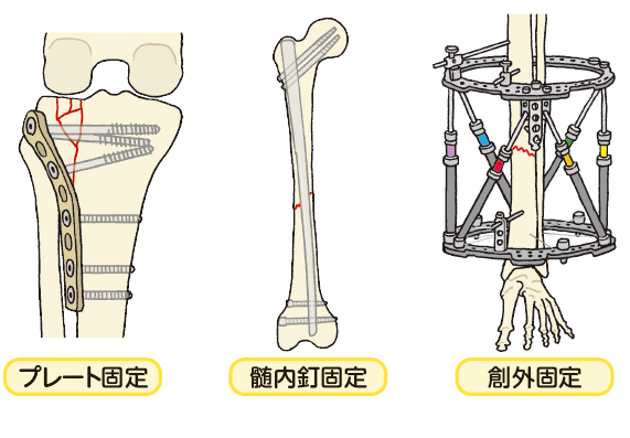 骨折の手術治療（おもな３つ）：| かんテキWeb