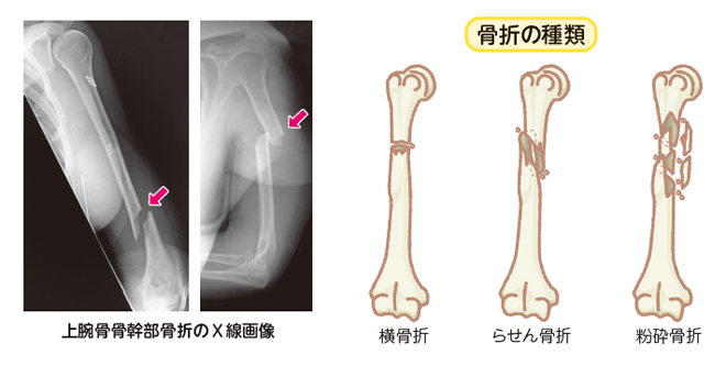 上腕骨骨幹部骨折：| かんテキWeb