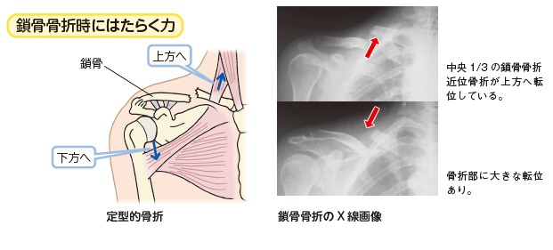 鎖骨骨折 かんテキweb