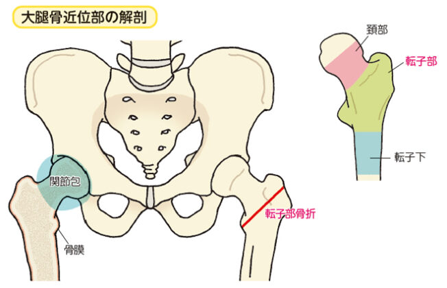 大腿骨転子部骨折：| かんテキWeb