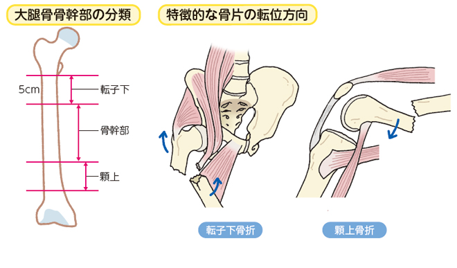 大腿骨骨幹部骨折：| かんテキWeb