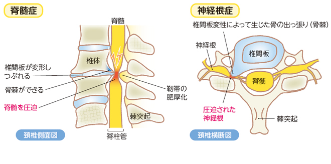 頚椎症性脊髄症 / 神経根症：| かんテキWeb