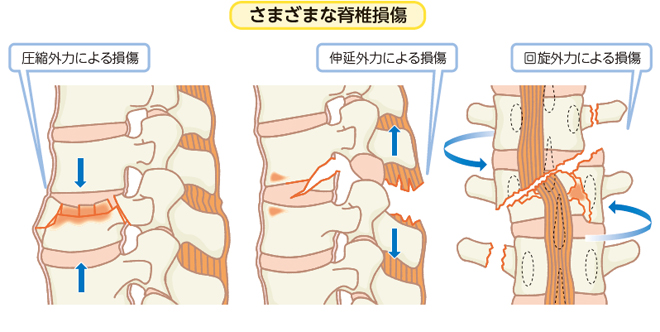 日本に 【裁断済み】脊椎脊髄損傷アドバンス(改訂第2版) 健康/医学 