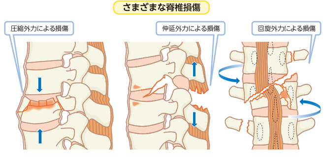 脊椎損傷：| かんテキWeb