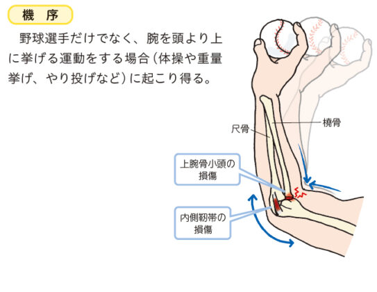 野球肘（離断性骨軟骨炎）：OCD| かんテキWeb