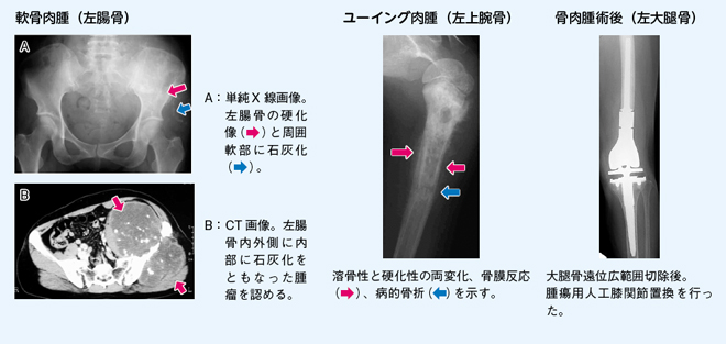 悪性骨腫瘍：| かんテキWeb